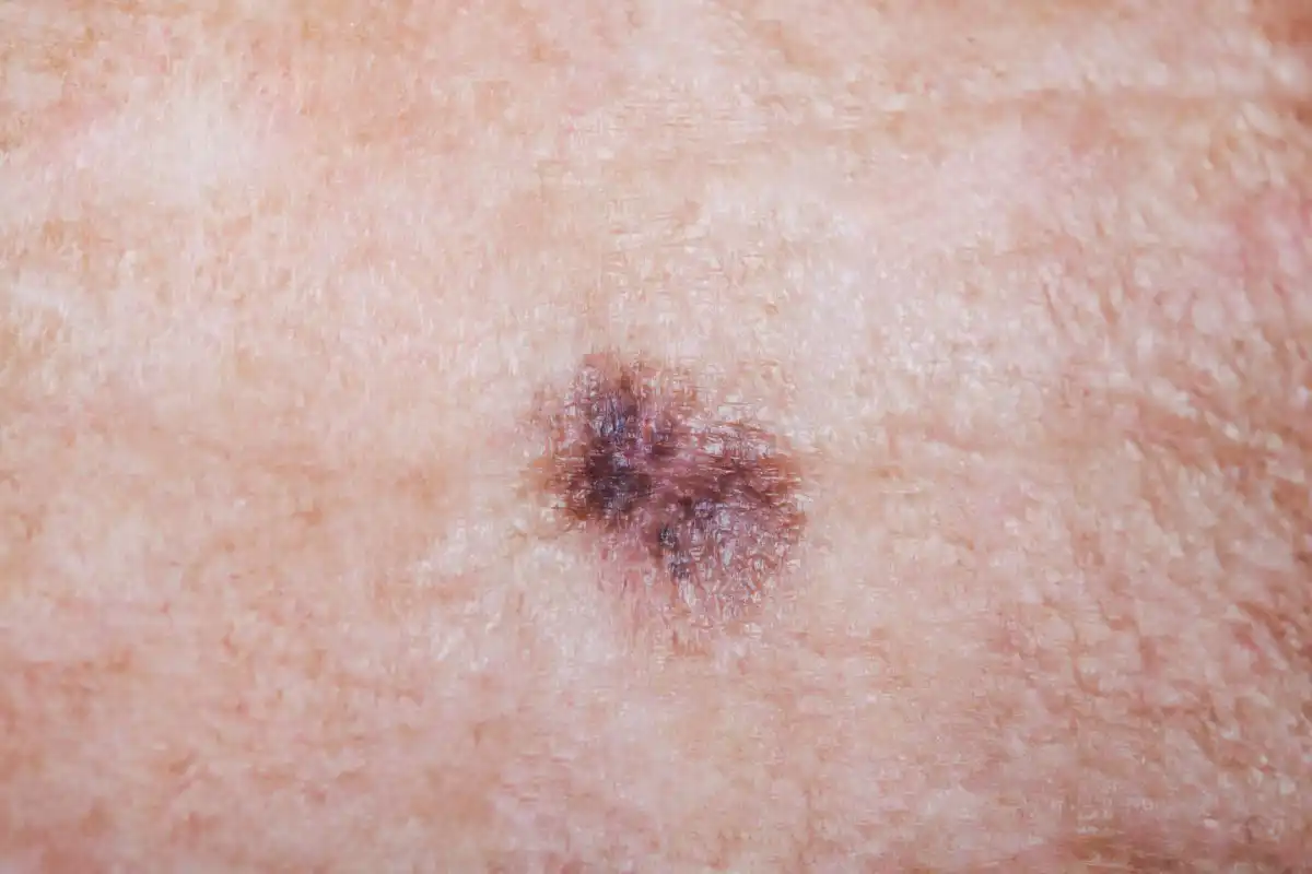 melanomafecciones180526
